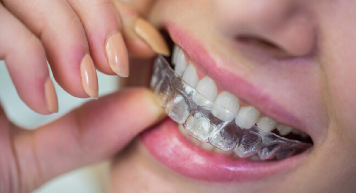 clear aligners - the smart solution for gapped teeth