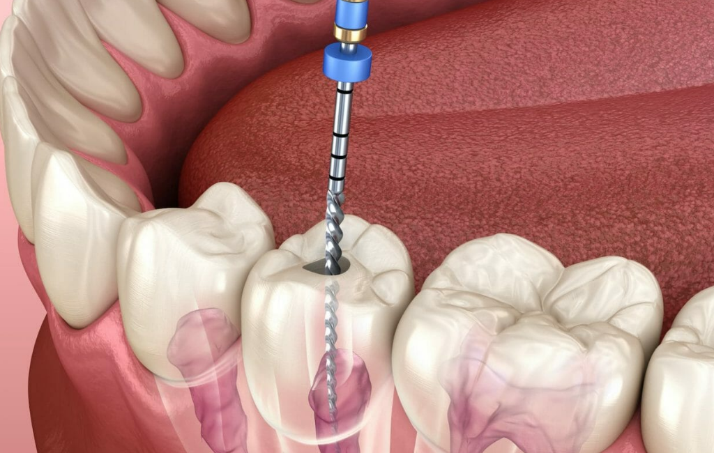 how root canals help save your teeth from extraction