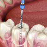 how root canals help save your teeth from extraction