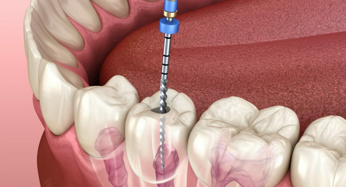 how root canals help save your teeth from extraction