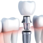 transform your smile after a major dental accident with implants