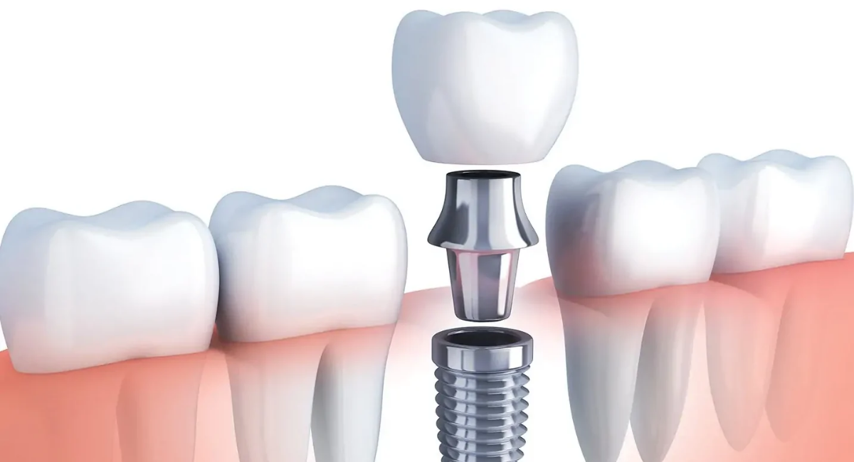 transform your smile after a major dental accident with implants