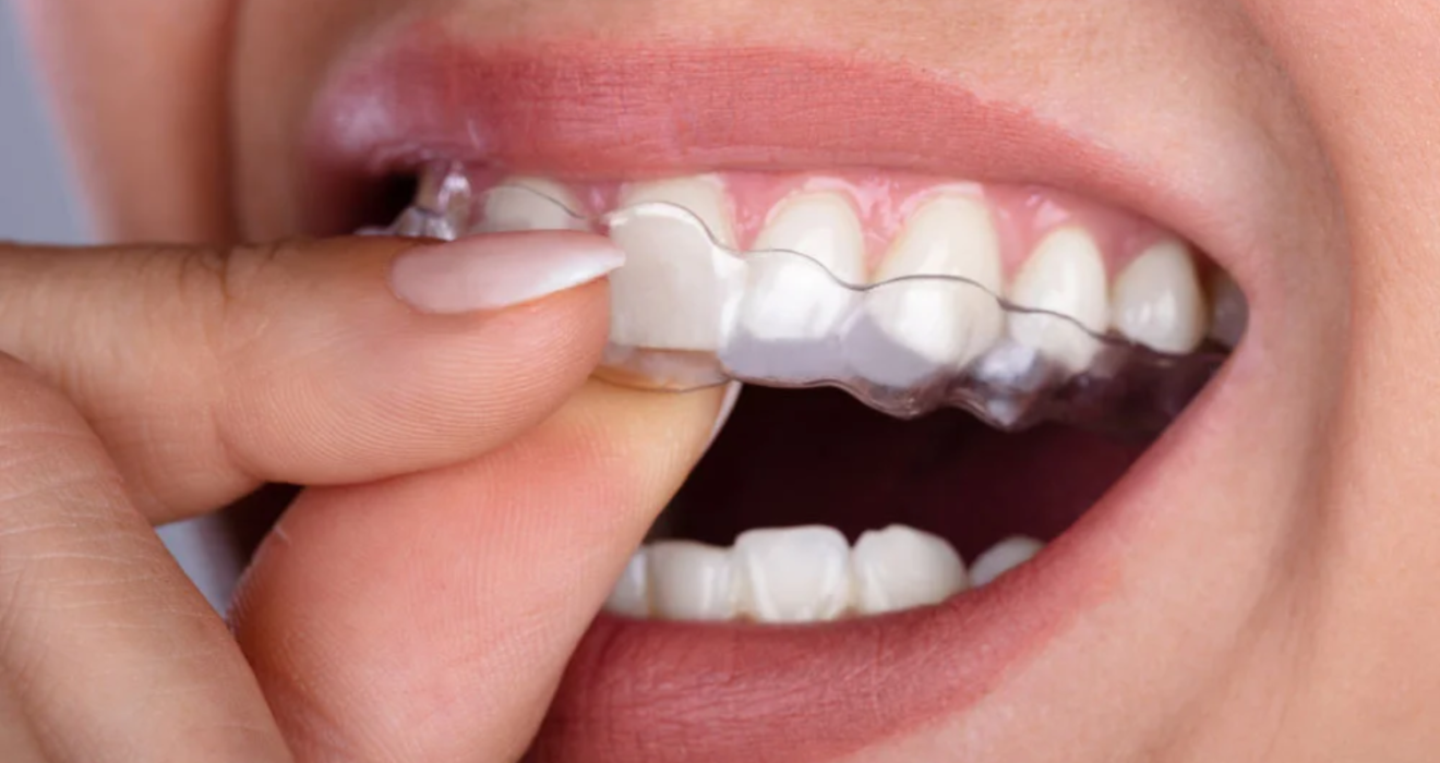 why clear aligners are becoming the best orthodontic treatments beating braces