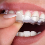 why clear aligners are becoming the best orthodontic treatments beating braces