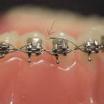 Broken Braces - Quick Steps to Take Before Seeing Your Orthodontist