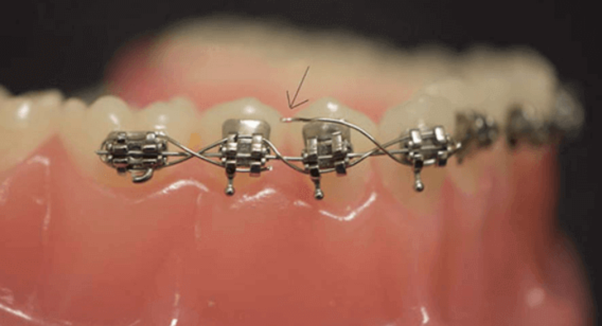 Broken Braces - Quick Steps to Take Before Seeing Your Orthodontist