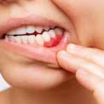 Gum Bleeding Emergency - Here's What to Do Before You See Your Dentist