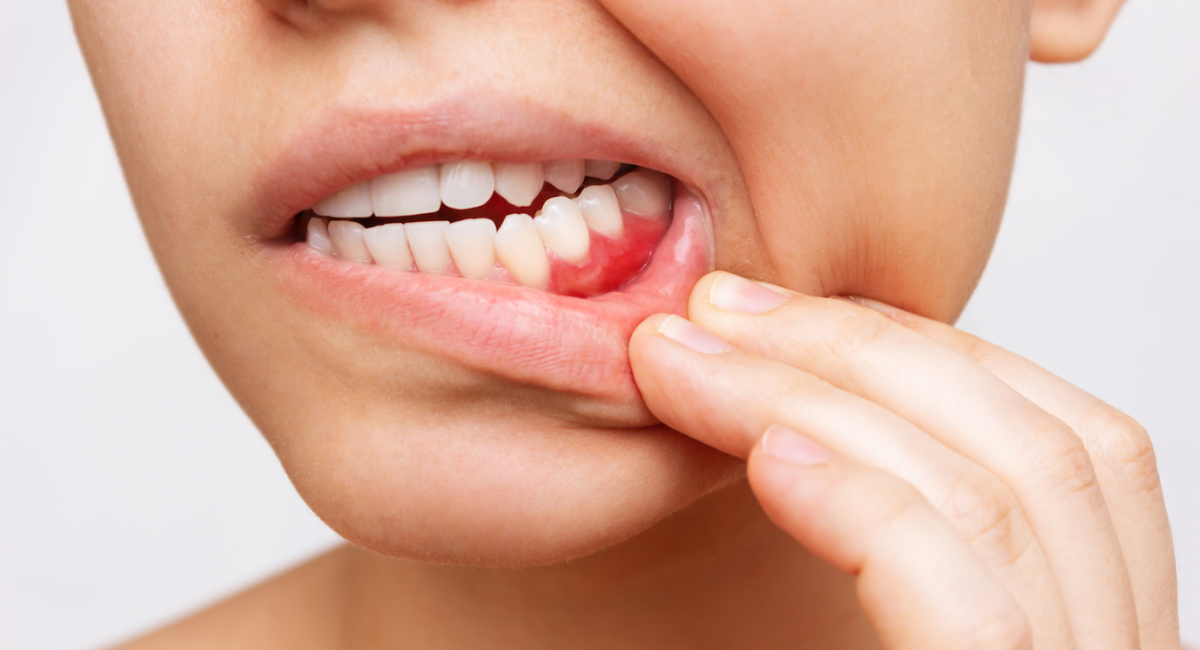 Gum Bleeding Emergency - Here's What to Do Before You See Your Dentist