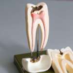 Surprising Benefits of Root Canals You Didn’t Know About