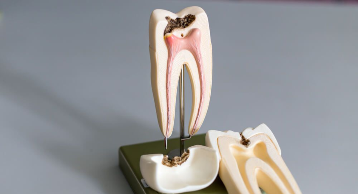 Surprising Benefits of Root Canals You Didn’t Know About