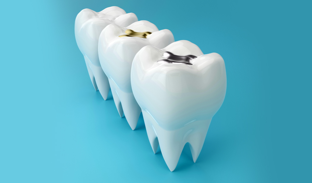 When Dental Fillings Fail - Warning Signs and What to Do Next