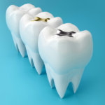 When Dental Fillings Fail - Warning Signs and What to Do Next