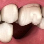What Happens If You Leave a Missing Tooth Untreated