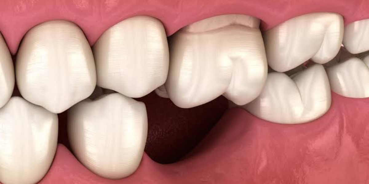 What Happens If You Leave a Missing Tooth Untreated