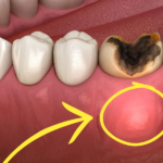 dental abcess