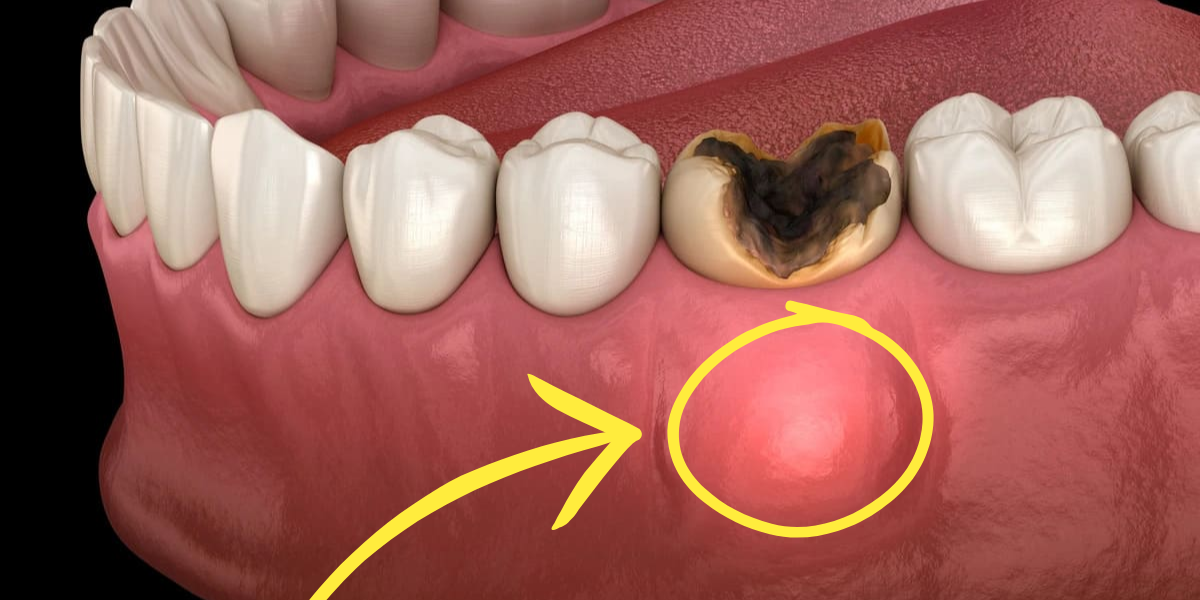 dental abcess