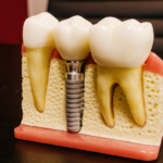 Can You Get Dental Implants If You Have Bone Loss