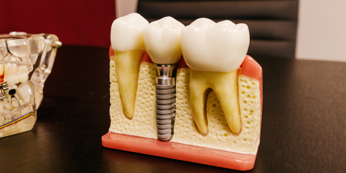 Can You Get Dental Implants If You Have Bone Loss