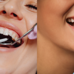 Dental Bonding vs Veneers - Which Is Better for Your Smile