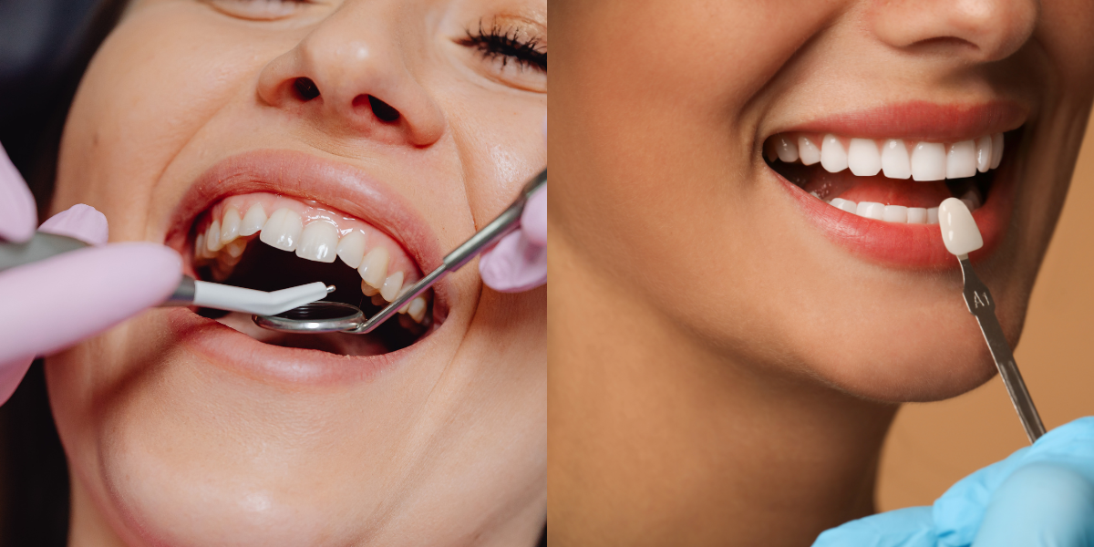 Dental Bonding vs Veneers - Which Is Better for Your Smile