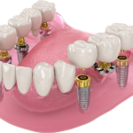 How Long Do Dental Implants Last_ Factors That Affect Their Lifespan