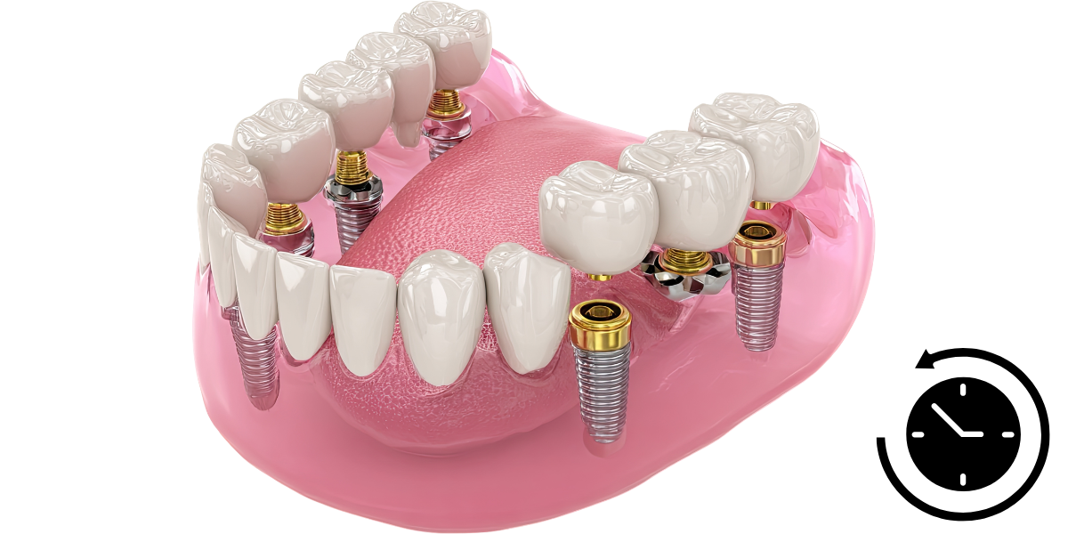How Long Do Dental Implants Last_ Factors That Affect Their Lifespan