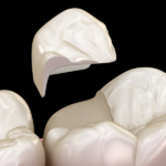 How to Know If You Have a Cracked Tooth
