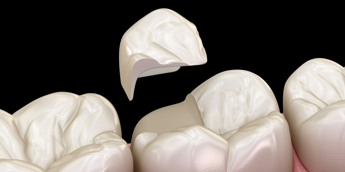 How to Know If You Have a Cracked Tooth